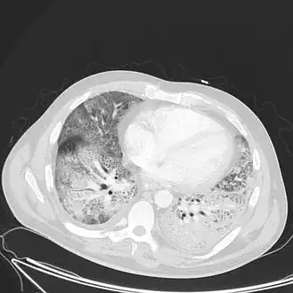 Acute respiratory distress syndrome