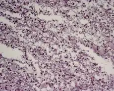 Aggressive multiple sclerosis