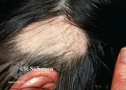 Alopecia areata