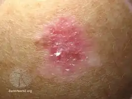 Amelanotic superficial spreading melanoma in situ
