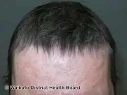 Anagen effluvium- regrowth after chemotherapy