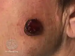 Atypical fibroxanthoma