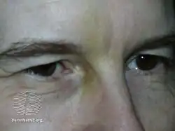 Botox injection-bruise