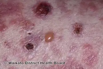 Bullous pemphigoid induced by pembrolizumab