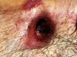 Primary cutaneous anaplastic large cell lymphoma(CD30+ lymphoma)