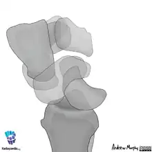Midcarpal dislocation