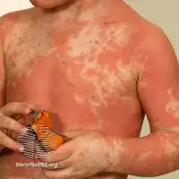 Pityriasis rubra pilaris