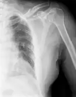 Clavicle fracture