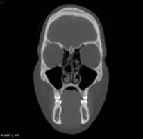 Large concha bullosa