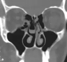Right concha bullosa with air fluid level within