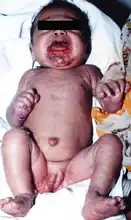 Early onset rash of congenital syphilis
