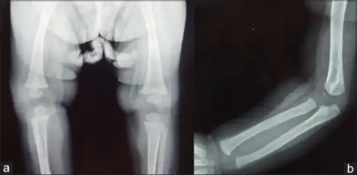 Wimberger corner sign; X-rays of (a) lower limbs (AP view) and (b) upper limbs (AP view) showing resolution of metaphyseal erosions and periosteal reaction