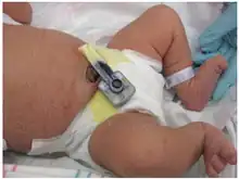 Congenital syphilis rash