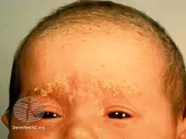 Cradle cap