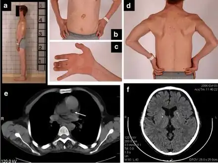 a) Thin habitus b)gastrostomy tube c) clawed hand d) muscle wasting upper trunk e)calcification left coronary artery f) atrophy and calcifications of the basal ganglia