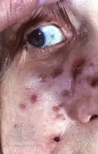 Skin tuberculosis on face