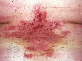 Darier disease before acitretin