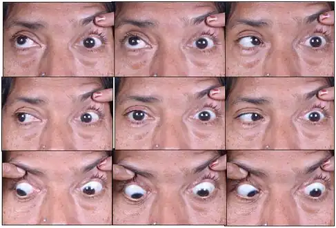 Image of a individual with orbital apex syndrome(limitation of motility gazes in left eye)