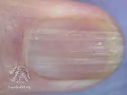 Onychorrhexis in elderly