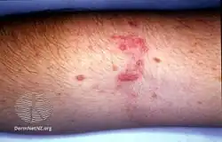 Elastosis perforans serpiginosa