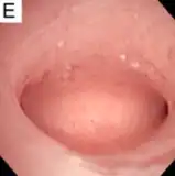 No recurrence after removal