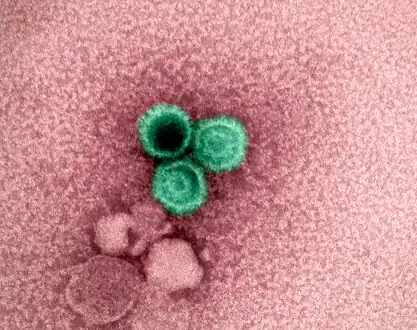 Electron micrograph showing three Epstein-Barr virus[61]