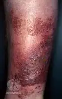 Erysipelas leg
