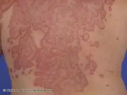 Erythema gyratum repens