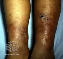Erythema induratum