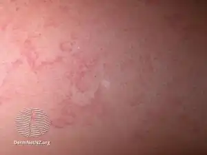 Erythema marginatum