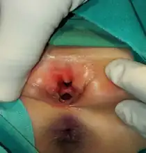 female epispadias: Bifid clitoris, depressed mons with normal vaginal opening