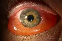 Severe chemosis of the lower conjunctiva due to thyroid eye disease.