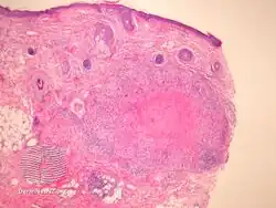 Lupus miliaris disseminatus faciei/pathology