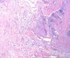 Myxofibrosarcoma-pathology