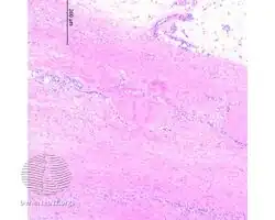 Eosinophilic fasciitis/pathology