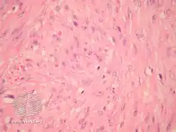 Infantile digital fibromatosis/pathology