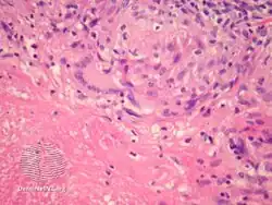 Lupus miliaris disseminatus faciei/pathology