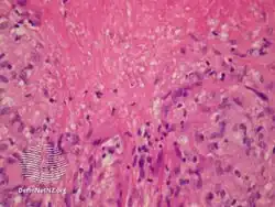 Lupus miliaris disseminatus faciei/pathology