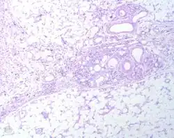 Myxofibrosarcoma-pathology
