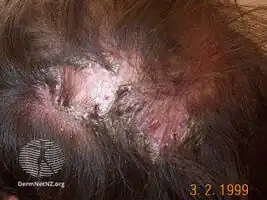 Folliculitis decalvans