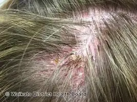 Folliculitis decalvans