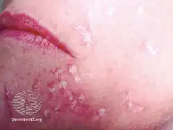 Frosting after applying trichloracetic acid in TCA CROSS procedure