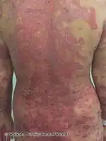 Generalised pustular psoriasis