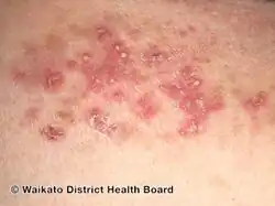 Generalised pustular psoriasis