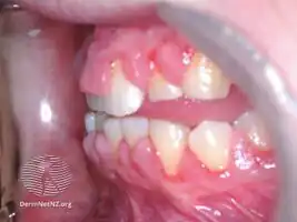 Gingival enlargement