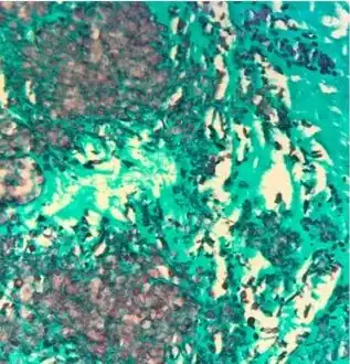 Gomori methenamine silver stain highlights numerous budding yeast and occasional pseudohyphal forms in mitral valve corresponding to C. lusitaniae recovered from culture