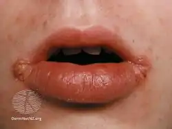 Granulomatous cheilitis