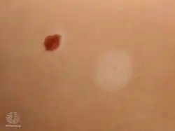 Halo mole