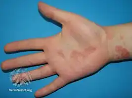 Hand eczema