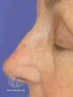 Day 0 on actinic keratoses